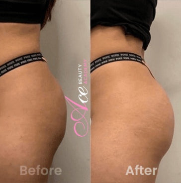 Vacuum Therapy BBL Training