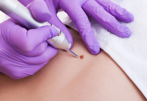 Skin Tag Removal Training ( Special Promo )