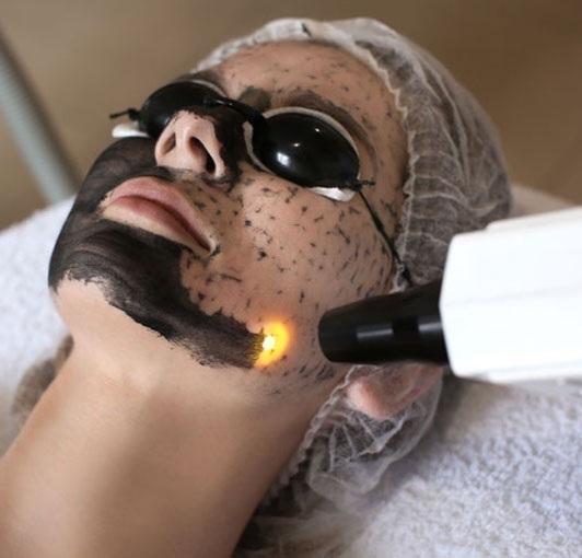 Carbon Peel Laser Training