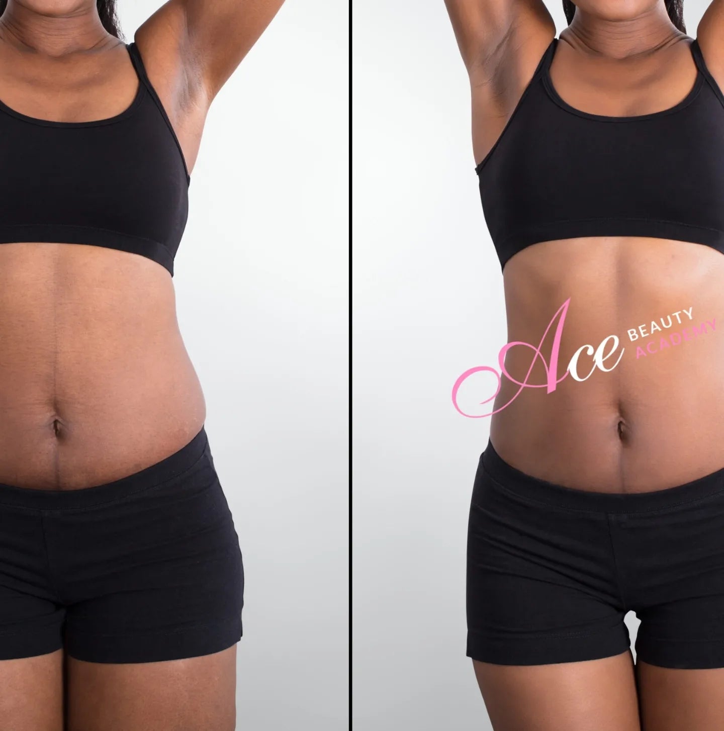 Body Contouring – Get back your curves - Ozhean